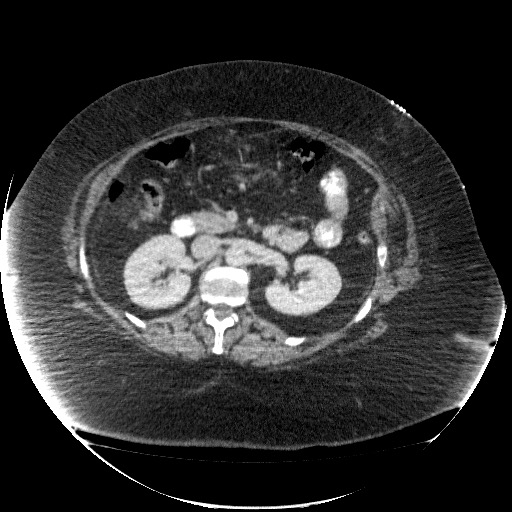 File:Collection due to leak after sleeve gastrectomy (Radiopaedia 55504-61972 A 35).jpg