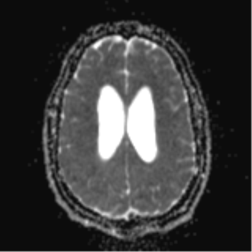 File:Colloid cyst (Radiopaedia 44510-48181 Axial ADC 20).png