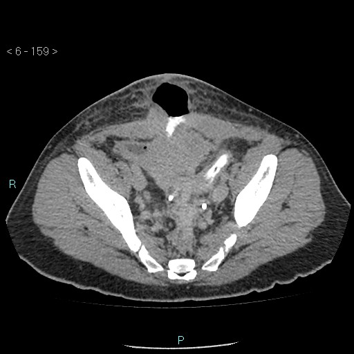 File:Colo-cutaneous fistula (Radiopaedia 40531-43129 A 66).jpg