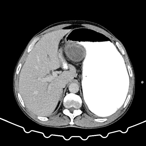 File:Colocolic intussusception due to large lipoma (Radiopaedia 68773-78482 A 33).jpg