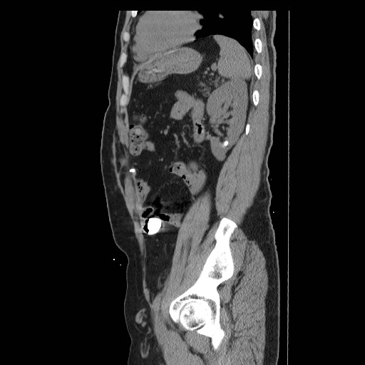 File:Colocutaneous fistula in Crohn's disease (Radiopaedia 29586-30093 F 36).jpg