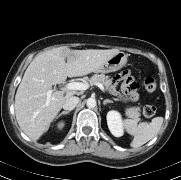 Colon carcinoma with hepatic metastases (Radiopaedia 29477-29961 A 33).jpg