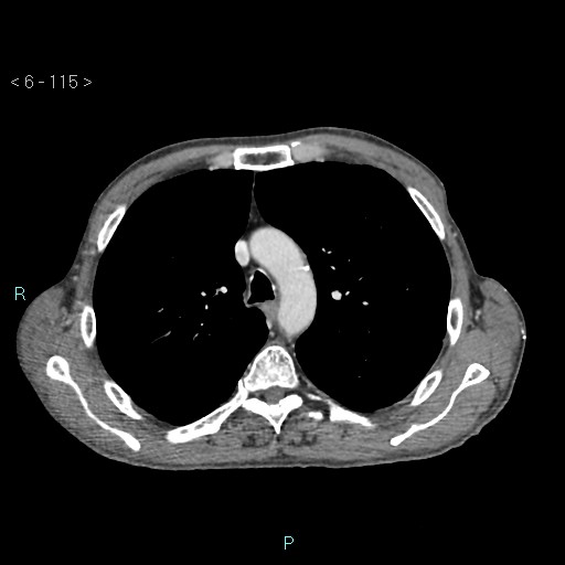 Colonic cancer (ultrasound and TC imaging) (Radiopaedia 50346-55713 B 115).jpg