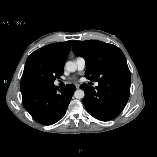Colonic cancer (ultrasound and TC imaging) (Radiopaedia 50346-55713 B 187).jpg