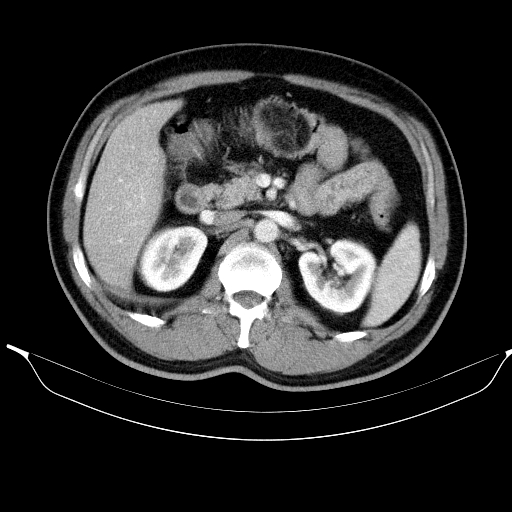 Colonic lipoma with colo-colic intussusception (Radiopaedia 58944-66200 A 22).jpg