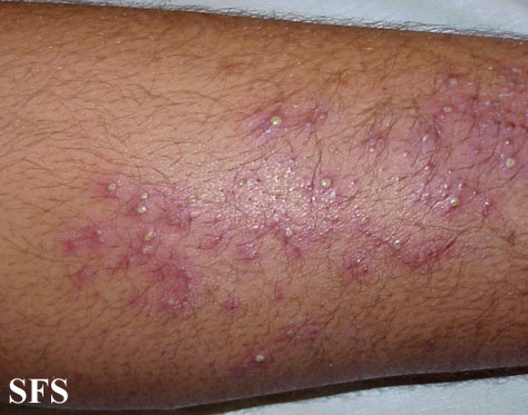 File:Folliculitis (Dermatology Atlas 7).jpg