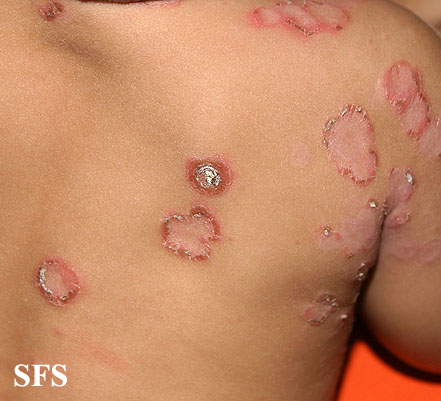 File:Impetigo (Dermatology Atlas 36).jpg