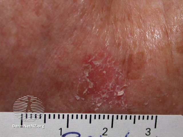Intraepidermal carcinoma (DermNet NZ lesions-scc-in-situ-2936).jpg