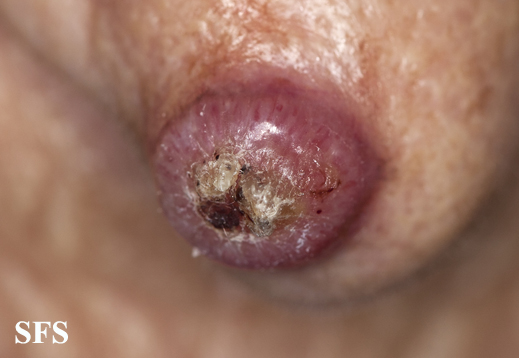 File:Keratoacanthoma (Dermatology Atlas 63).jpg