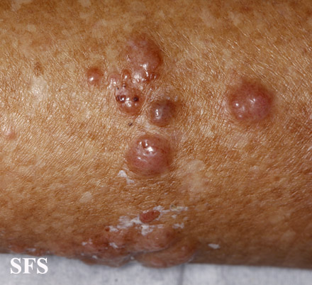 File:Melanoma (Dermatology Atlas 65).jpg
