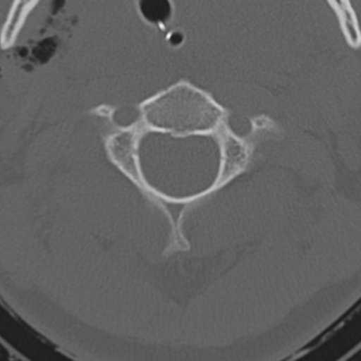 File:Multitrauma with diffuse axonal injury, temporal bone fractures and traumatic caroticocavernous fistula (Radiopaedia 37242-39035 Axial 203).png