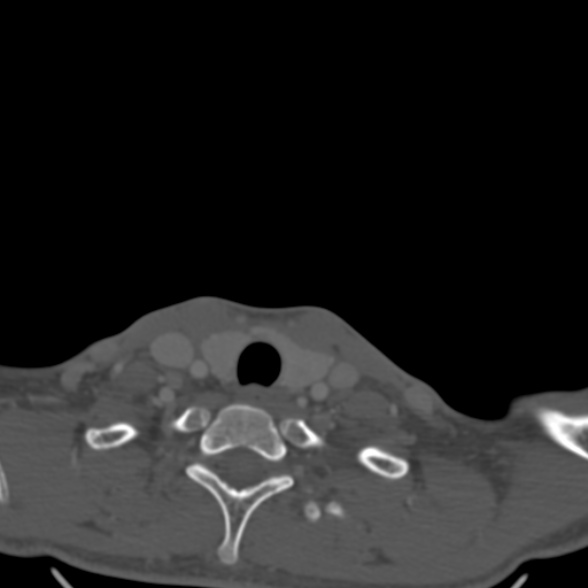 Nasopharyngeal carcinoma with skull base invasion (Radiopaedia 53415-59705 Axial bone window 186).jpg