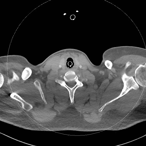 Neck CT angiogram (intraosseous vascular access) (Radiopaedia 55481-61945 B 135).jpg