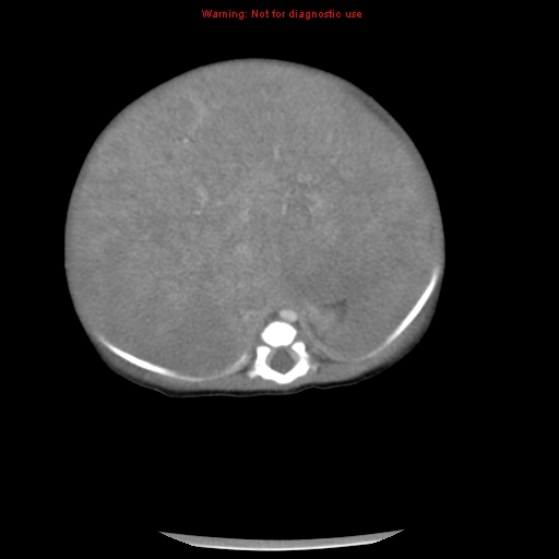 File:Neonatal neuroblastoma (Radiopaedia 9564-10223 A 19).jpg