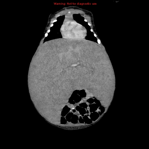 File:Neonatal neuroblastoma (Radiopaedia 9564-10223 B 44).jpg