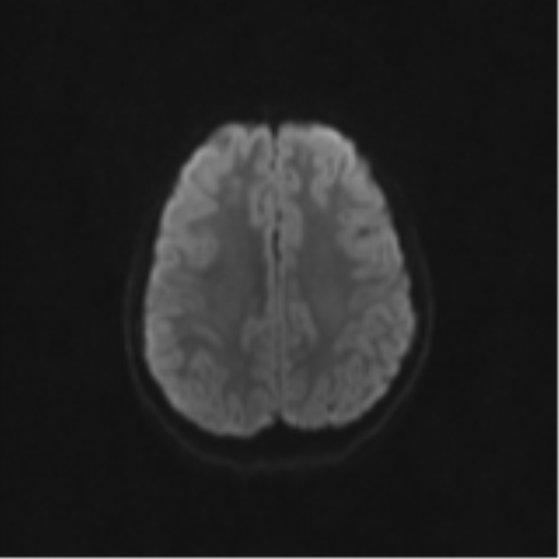 Neurenteric cyst (Radiopaedia 58641-65837 Axial DWI 60).png
