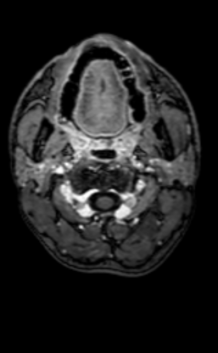 Neuro-Behçet disease (Radiopaedia 90112-107294 Axial T1 C+ 219).jpg
