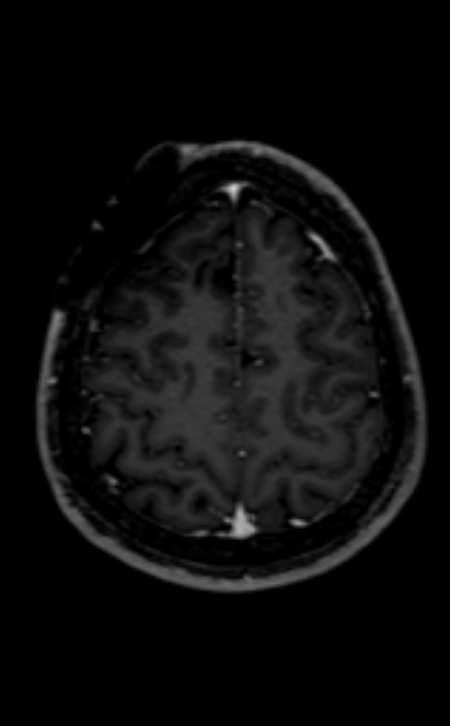 Neuro-Behçet disease (Radiopaedia 90112-107294 Axial T1 C+ 76).jpg