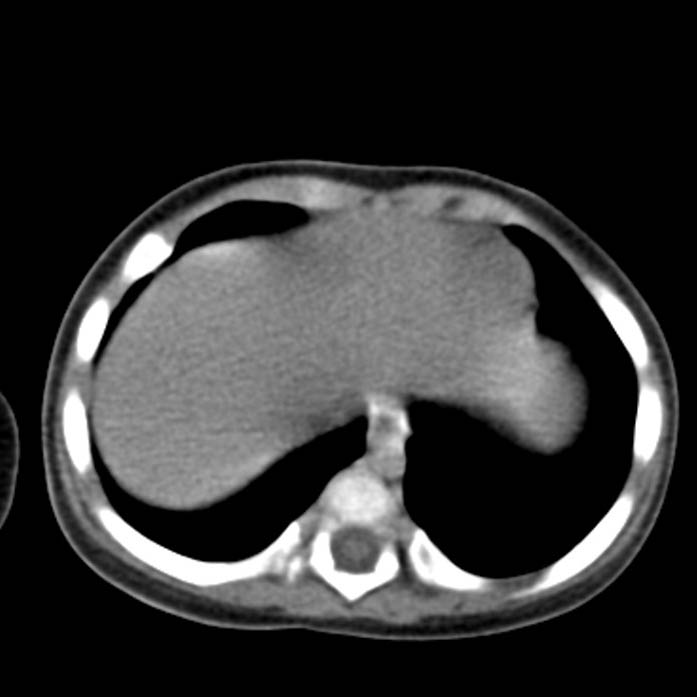 Neuroblastoma with skull metastases (Radiopaedia 30326-30960 Axial non-contrast 4).jpg