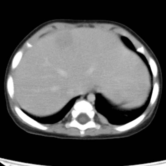 Neuroblastoma with skull metastases (Radiopaedia 30326-30960 C 6).jpg