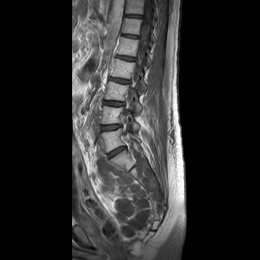 File:Neurofibromatosis type 1- extensive spinal involvement and Christmas tree sign (Radiopaedia 60610-68332 Sagittal T1 C+ 7).jpg