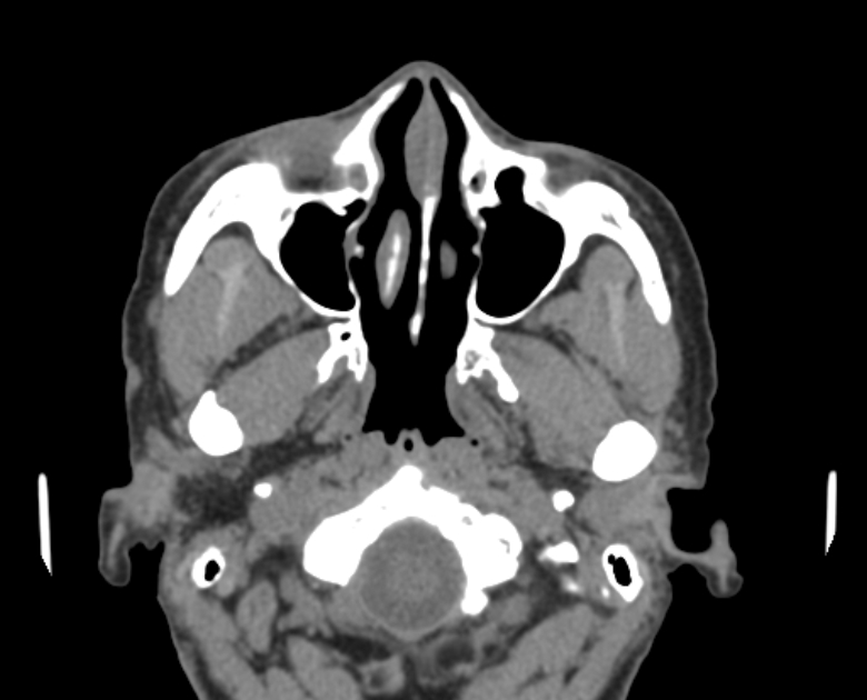 Neurofibromatosis type 1- orbital manifestations (Radiopaedia 49391-54511 Axial non-contrast 30).jpg