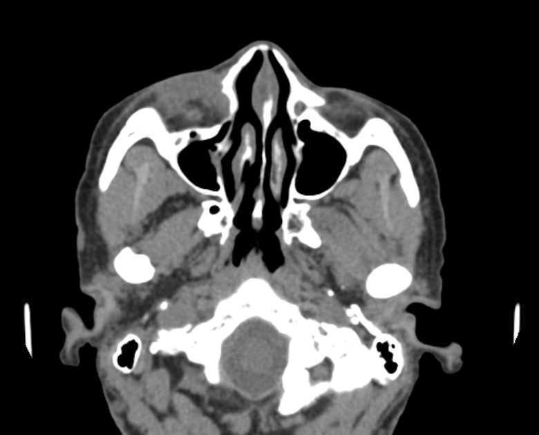 Neurofibromatosis type 1- orbital manifestations (Radiopaedia 49391-54511 Axial non-contrast 32).jpg