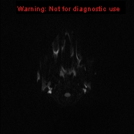 File:Neurofibromatosis type 1 with optic nerve glioma (Radiopaedia 16288-15965 Axial DWI 48).jpg