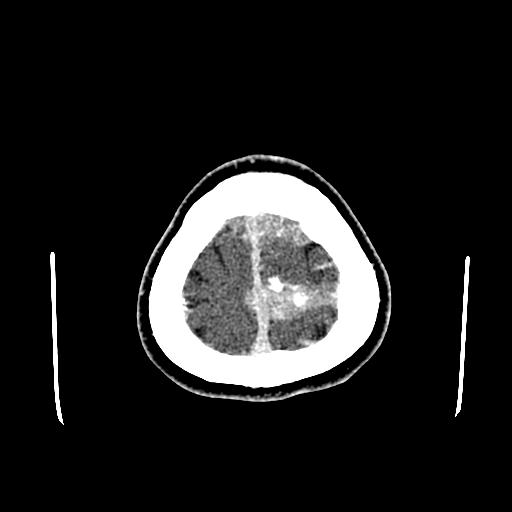 File:Neurofibromatosis type 2 (Radiopaedia 25389-25637 Axial C+ 95).jpg