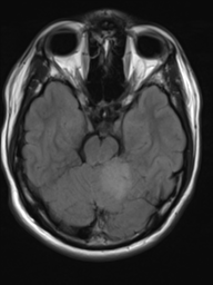 File:Neurofibromatosis type 2 (Radiopaedia 44936-48838 Axial FLAIR 8).png