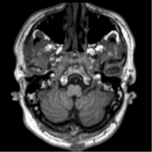File:Neurofibromatosis type 2 (Radiopaedia 44936-48838 Axial T1 16).png