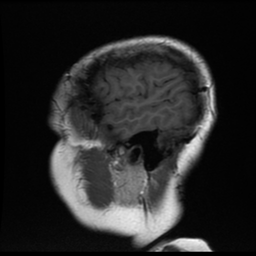 File:Neurofibromatosis type 2 (Radiopaedia 45229-49247 Sagittal T1 2).png