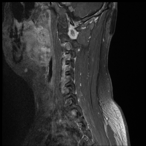 File:Neurofibromatosis type 2 (spinal manifestations) (Radiopaedia 53943-60070 G 3).png