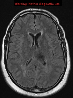File:Neuroglial cyst (Radiopaedia 10713-11184 Axial FLAIR 10).jpg