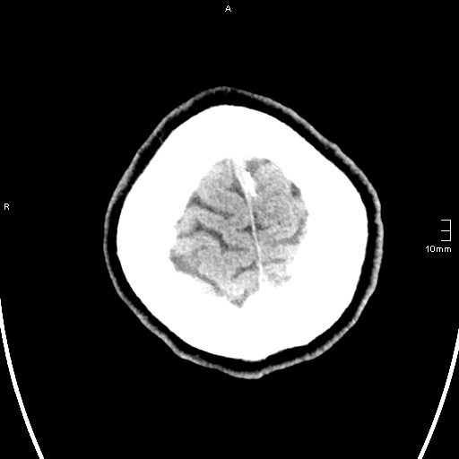 File:Neurotoxoplasmosis - concentric target sign (Radiopaedia 70644-80783 Axial non-contrast 38).jpg