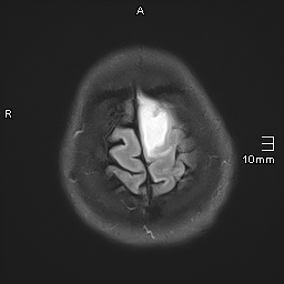 File:Neurotoxoplasmosis - concentric target sign (Radiopaedia 70644-80784 Axial FLAIR 20).jpg