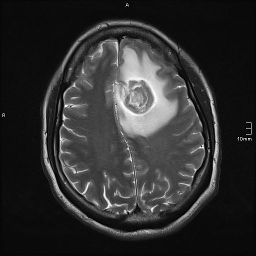 File:Neurotoxoplasmosis - concentric target sign (Radiopaedia 70644-80784 Axial T2 15).jpg