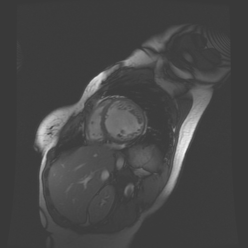 File:Non-compaction of the left ventricle (Radiopaedia 38868-41062 SAXs SSFP CINE 15).jpg