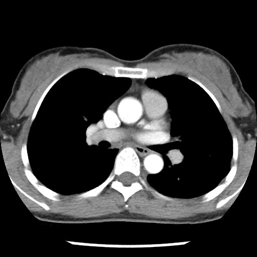 File:Non-small cell lung cancer with miliary metastases (Radiopaedia 23995-24193 A 20).jpg
