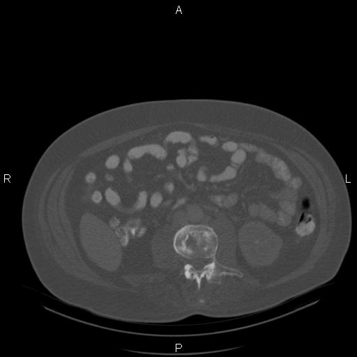 Non Hodgkin lymphoma in a patient with ankylosing spondylitis (Radiopaedia 84323-99624 Axial bone window 43).jpg