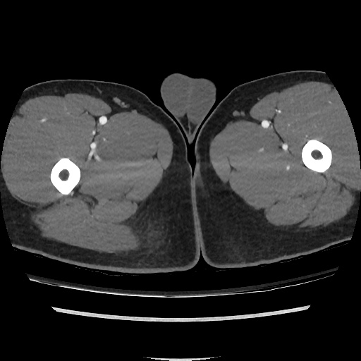 File:Normal CT angiogram of pelvis (Radiopaedia 45390-49430 A 69).jpg