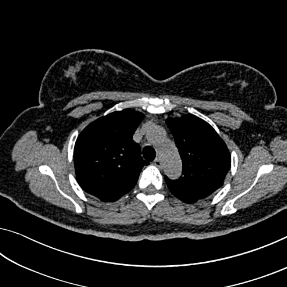 Normal CT chest- adult female (Radiopaedia 52522-58428 Axial non-contrast 38).jpg