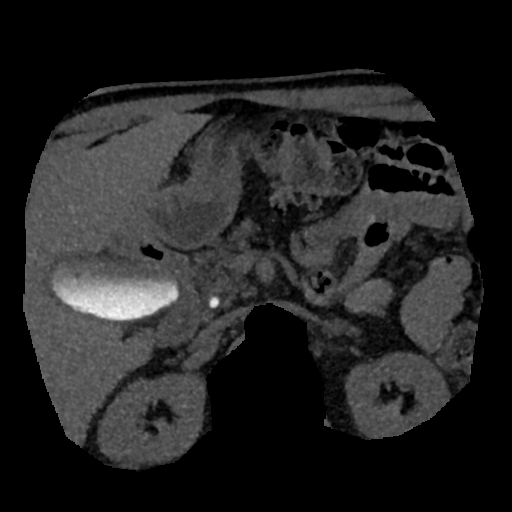 File:Normal CT intravenous cholangiogram (Radiopaedia 38199-40208 Axial IVC (MIP) 35).png