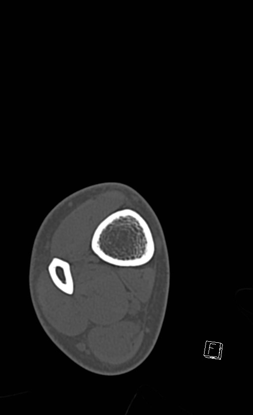 Normal CT of the ankle (Radiopaedia 47111-51658 Axial bone window 3).jpg