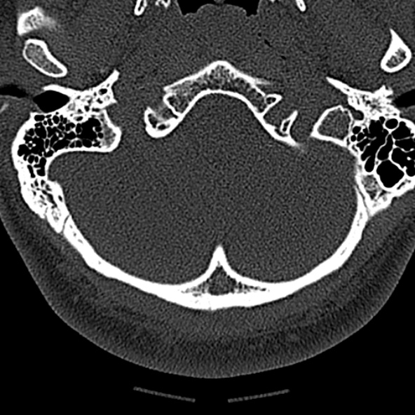 Normal CT of the cervical spine (Radiopaedia 53322-59305 Axial bone window 26).jpg