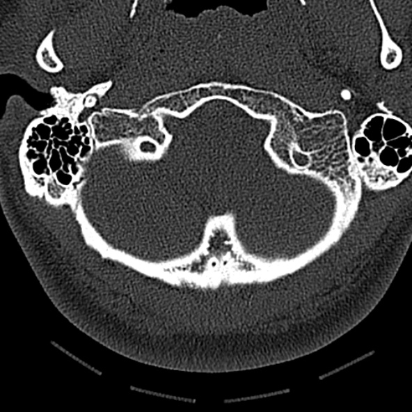 Normal CT of the cervical spine (Radiopaedia 53322-59305 Axial bone window 34).jpg