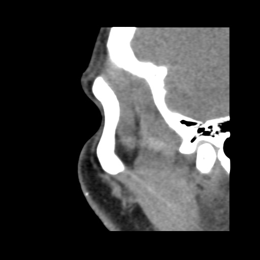 Normal CT paranasal sinuses (Radiopaedia 42286-45390 F 26).jpg