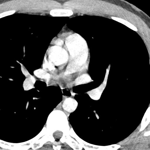 File:Normal CT pulmonary veins (pre RF ablation) (Radiopaedia 41748-44702 A 98).png