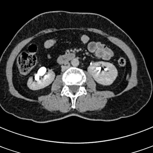 File:Normal CT split bolus study of the renal tract (Radiopaedia 48631-53634 Axial split bolus 117).jpg