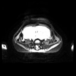 Normal MRI abdomen in pregnancy (Radiopaedia 88001-104541 Axial DWI 16).jpg